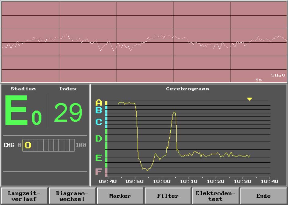 EEG Bildschirm